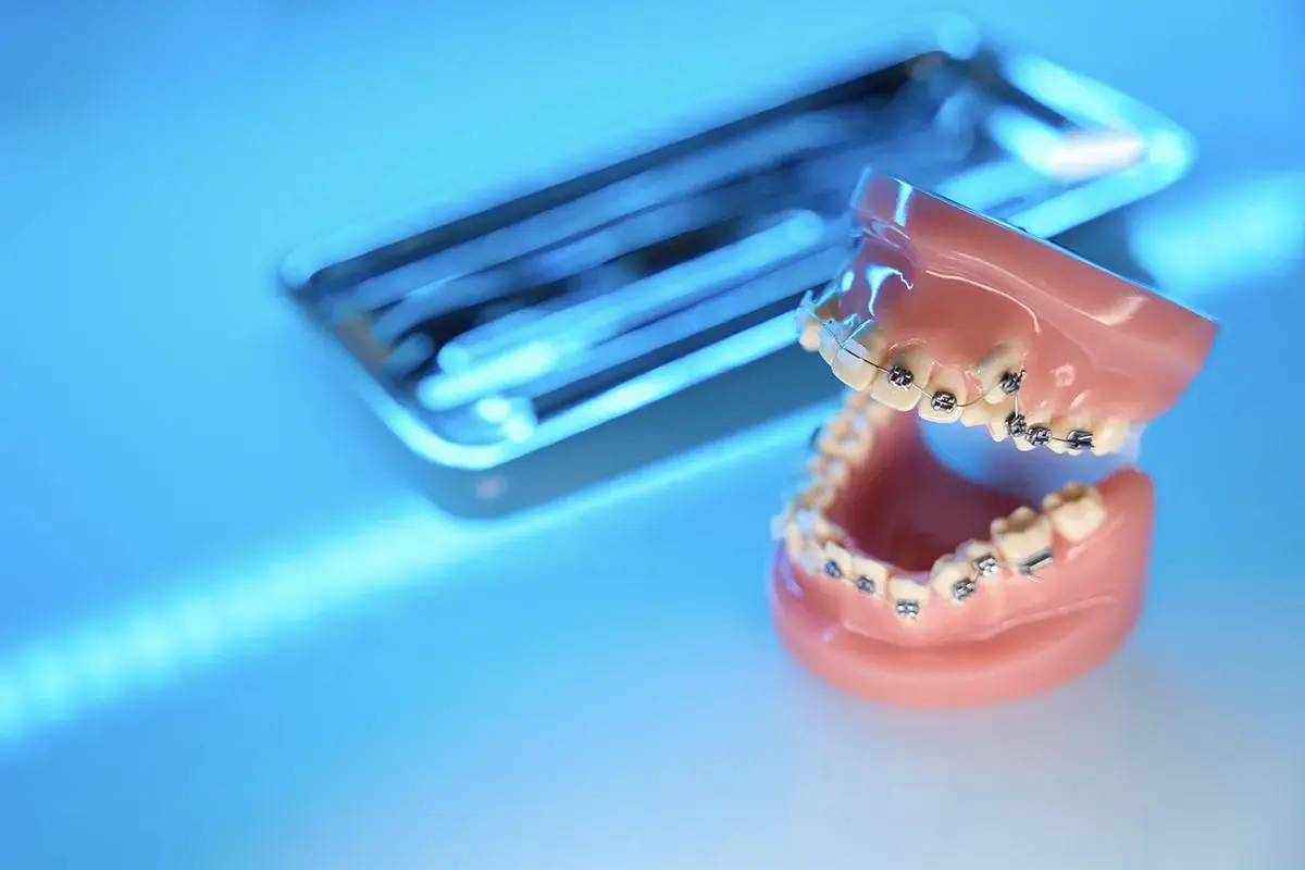 Traditional braces on a dental model with specialized orthodontic tools in the background