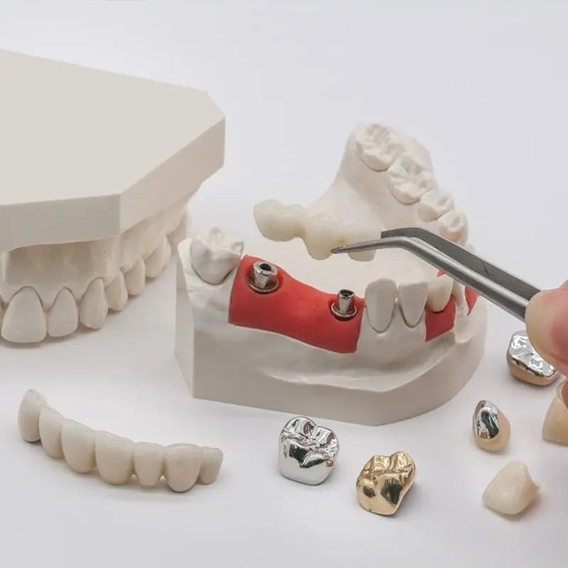 Dental models with a bridge, crowns and loose crowns on a white table