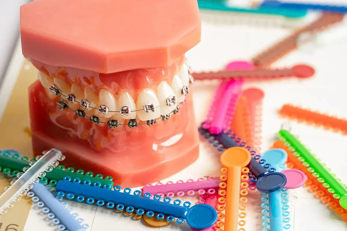 A dental model with metal braces surrounded by colorful orthodontic elastics and ligatures in various colors