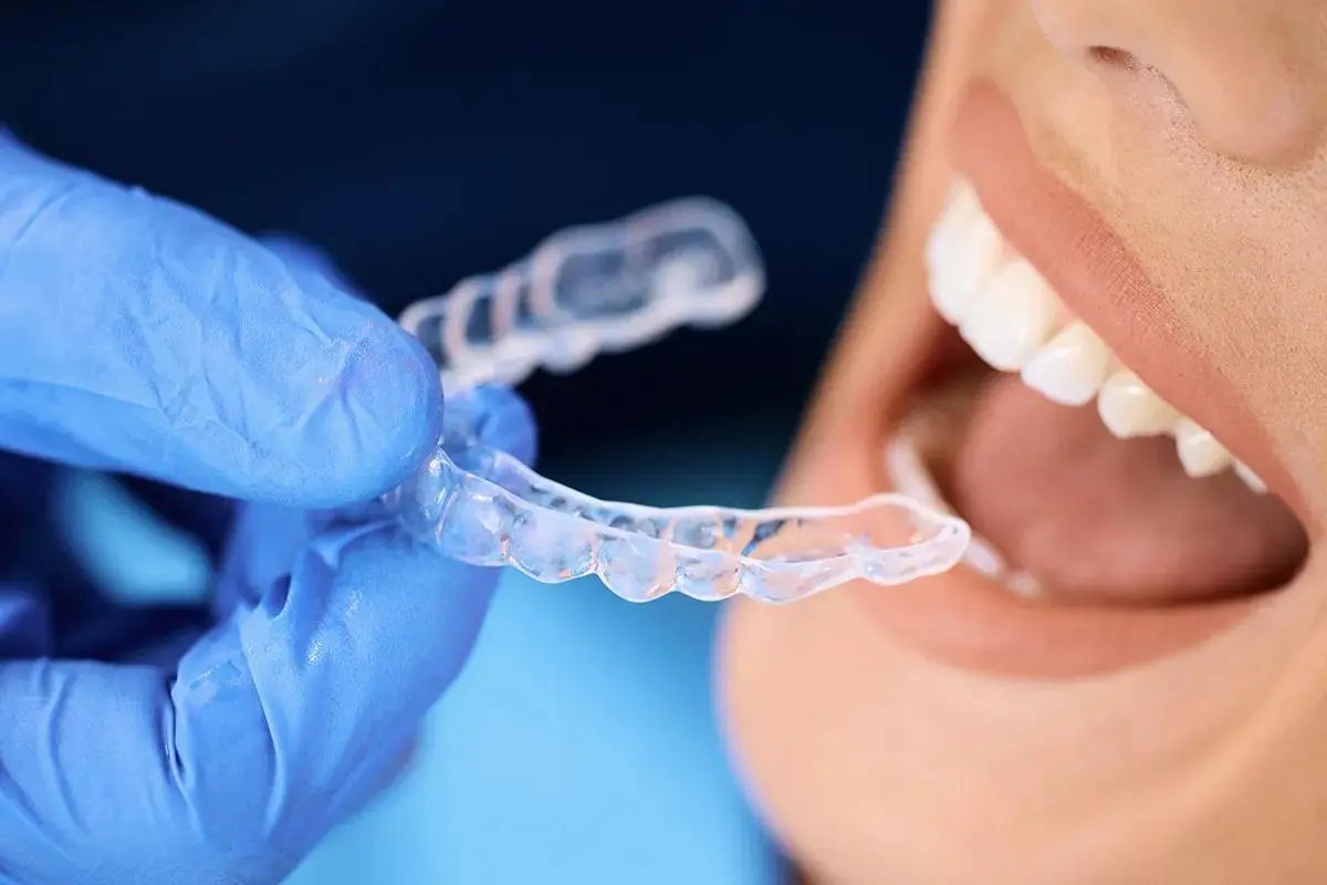 Close-up of a transparent Invisalign tray being positioned over a patient's perfectly aligned teeth