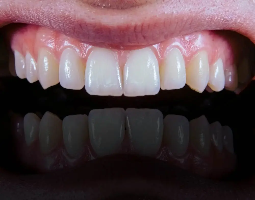 Close-up of a person's white teeth and pink gums, with reflection.
