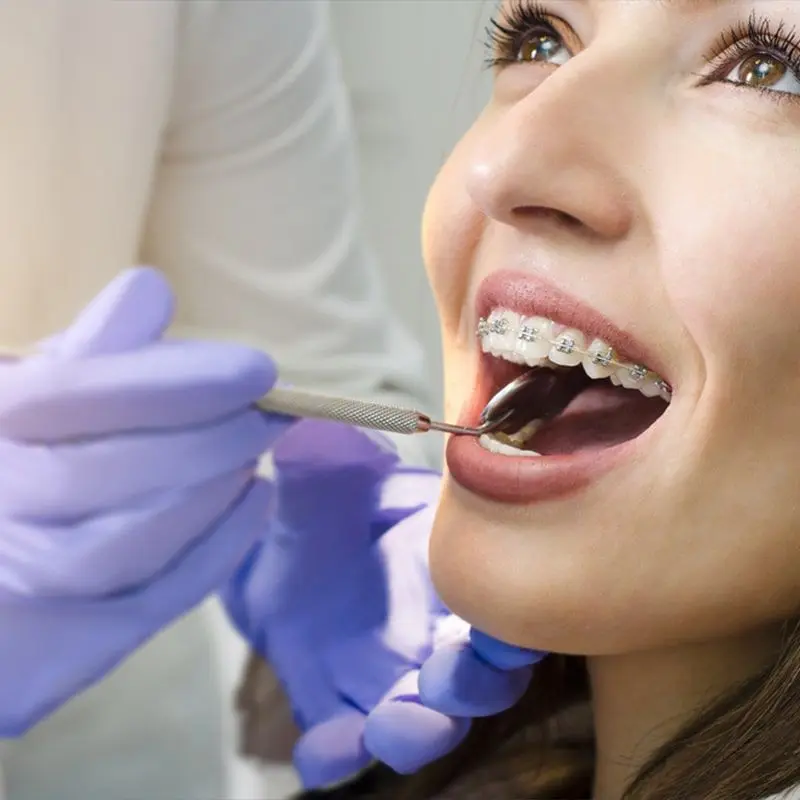 A smiling woman with braces while a gloved hand works on her teeth