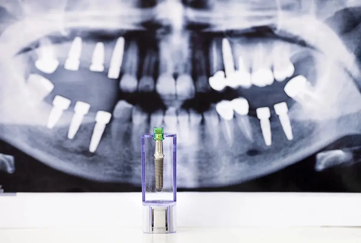 Dental implant screw displayed against panoramic X-ray showing multiple implants.