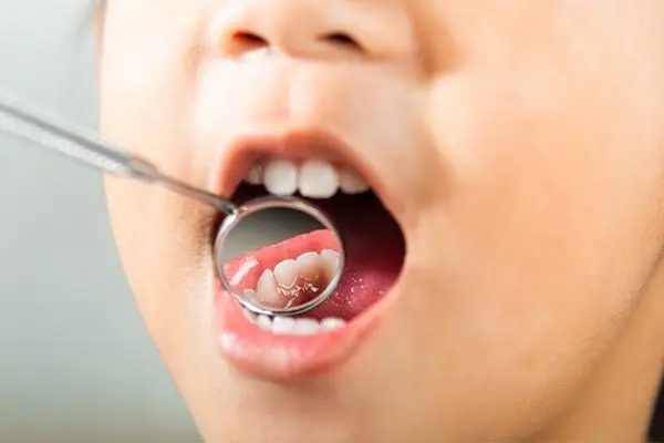 Cavities in 5 or 4-Year-Olds