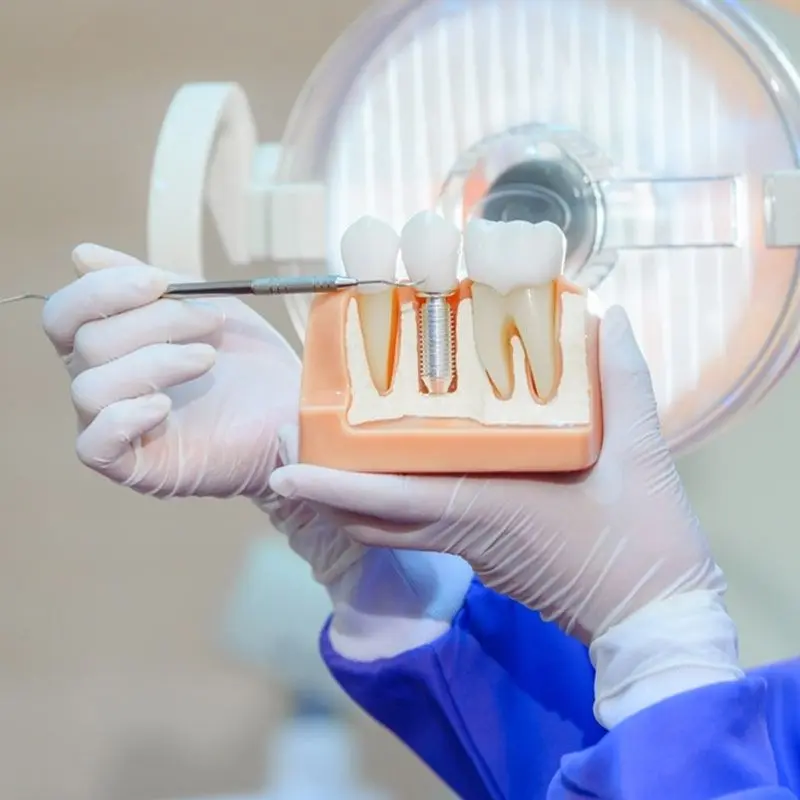 A dentist holds a model of a dental implant beside a natural tooth model