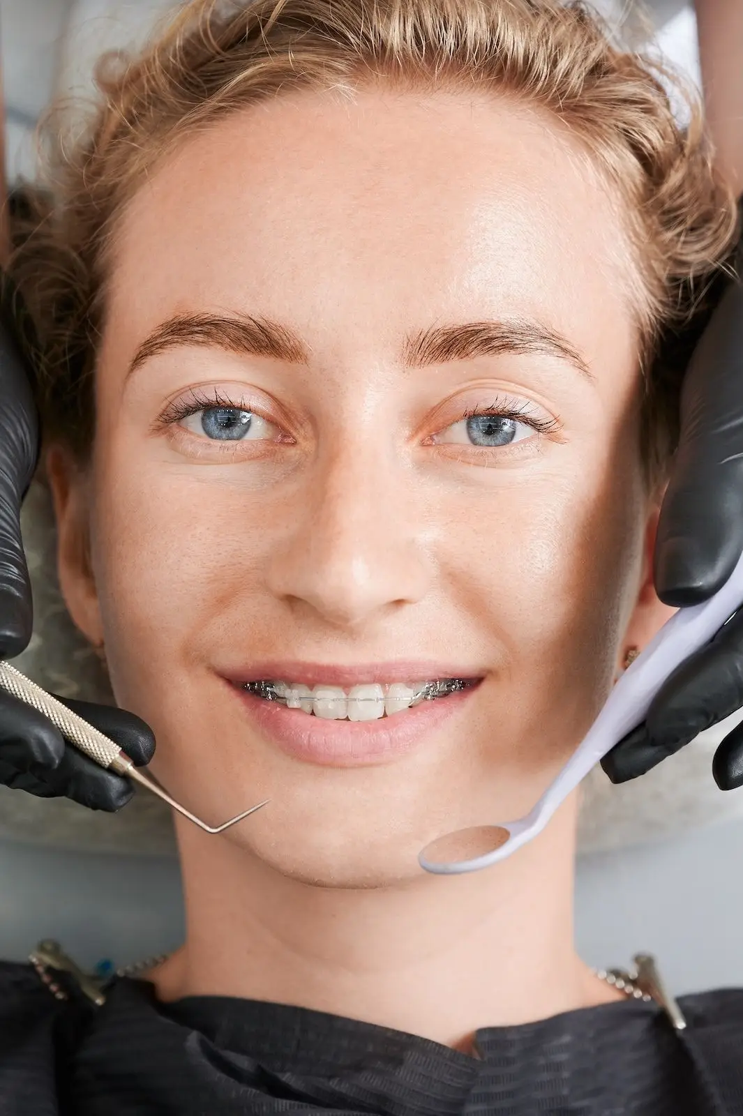 Cropped, closeup, macro photography of human's mouth with metal braces and cheek retractor. Copy space. Side view. Concept of medicine and dentistry