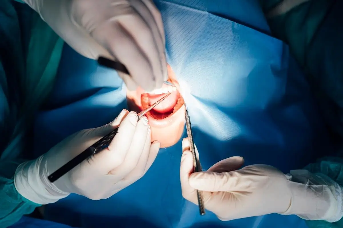 Tooth Extraction