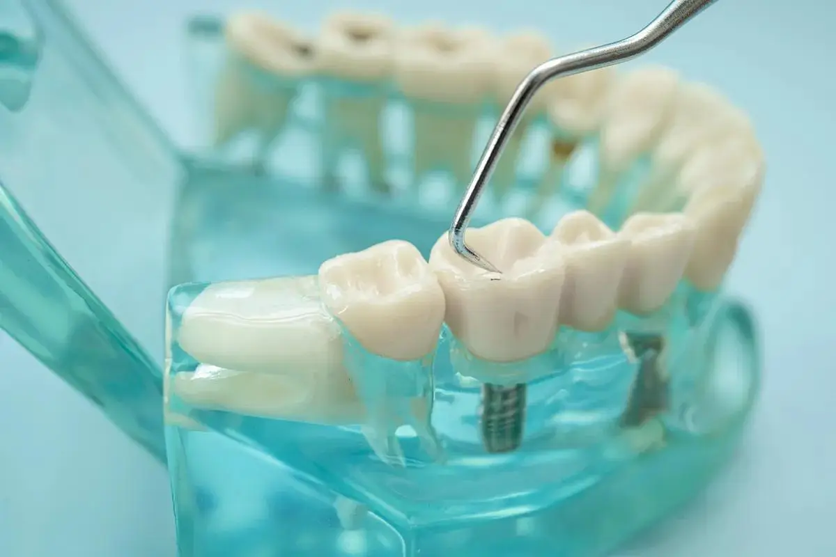 Close-up of a dental implant model showing artificial teeth attached to metal implants in a transparent base, with a dental tool pointing at the prosthetic.