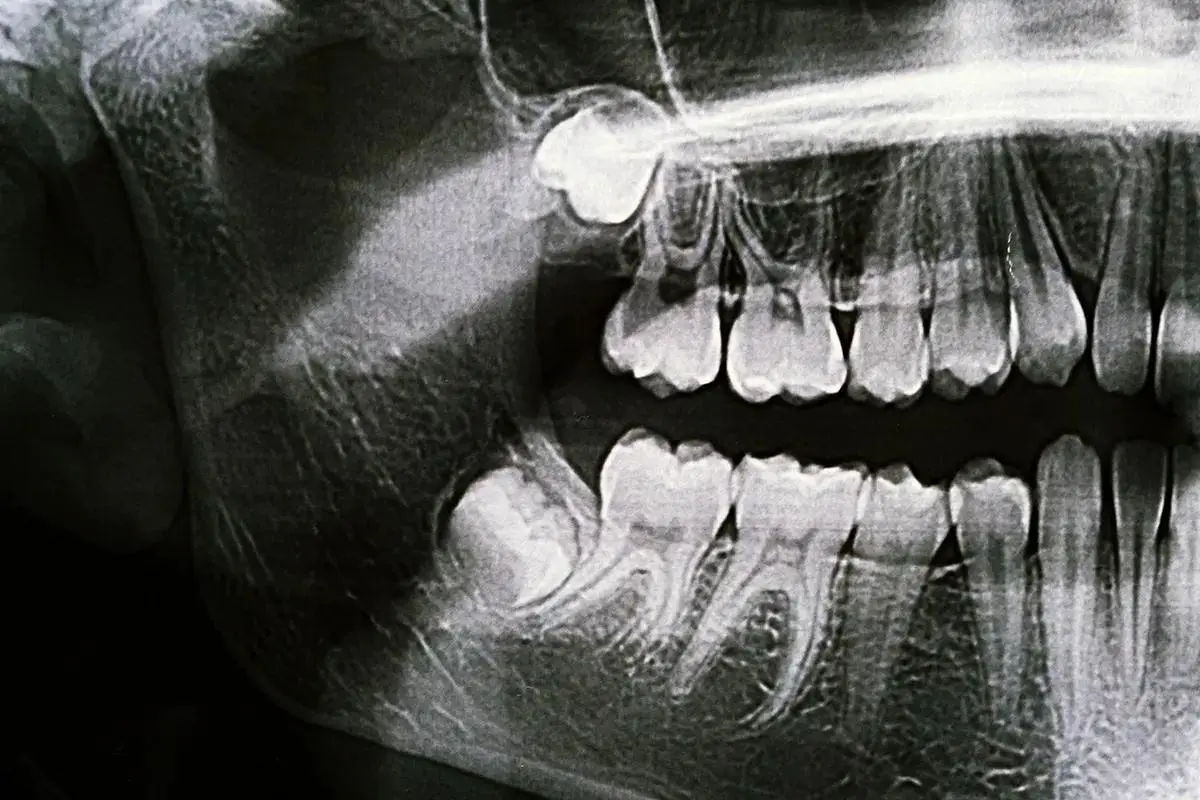 A model tooth with dental tools and a stethoscope on a blue background