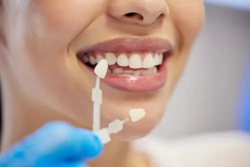 A smiling woman's teeth beside a tooth shade guide held by a gloved hand