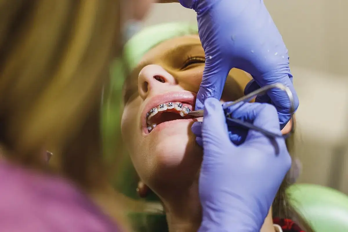 Dental braces adjustment procedure showing close-up of a patient with metal braces while a dental professional with purple gloves uses tools to work on the orthodontic appliance.