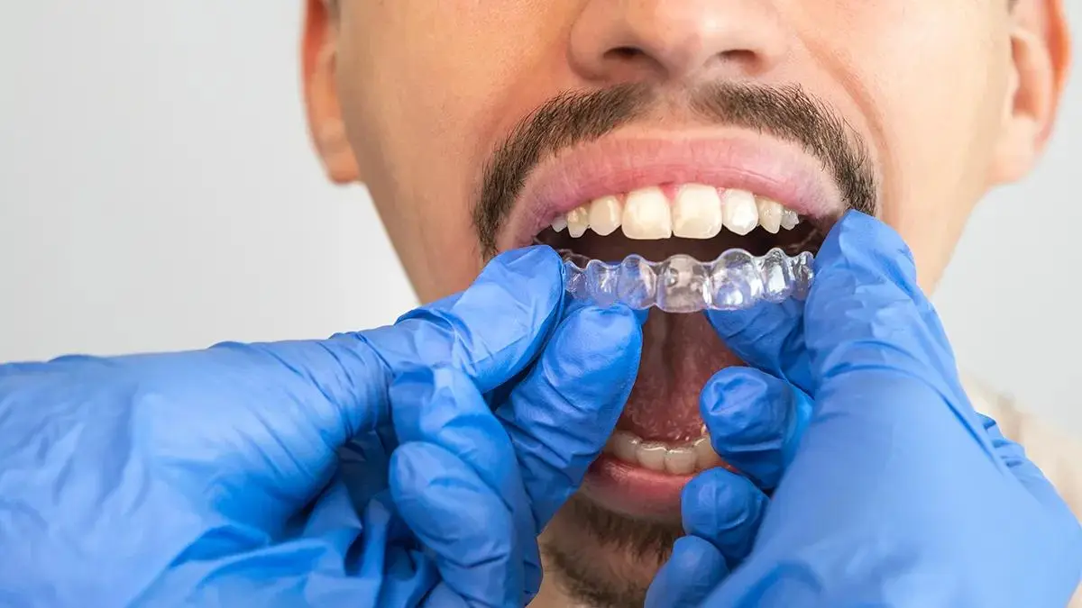 Dental professional fitting a clear Invisalign aligner on a patient's lower teeth